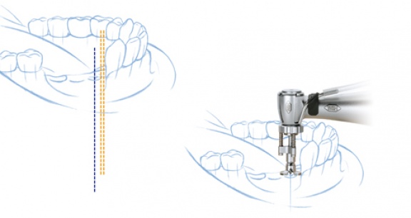 Thiết bị định vị khoảng cách cấy ghép IDC