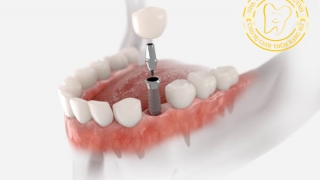 CÂU HỎI THƯỜNG GẶP VỀ CẤY GHÉP IMPLANT