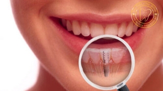 Cấy ghép implant tức thì giải pháp cho người dinh doanh bận rộn