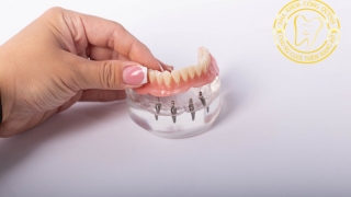 Trồng Implant có đau không? 