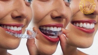 Niềng răng đầu năm – thay đổi nụ cười mà không ai nhận ra