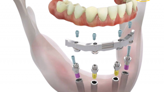 Mất răng hàm? Cắm Implant để ăn ngon, nói chuyện tự tin hơn