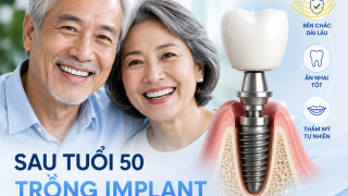 Sau tuổi 50 trồng Implant có cần chuẩn bị gì đặc biệt?