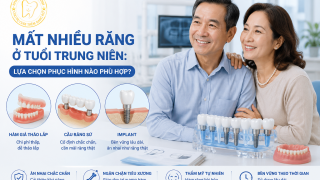 Mất nhiều răng ở tuổi trung niên: lựa chọn phục hình nào phù hợp