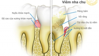 Điều trị nha chu là gì? Dấu hiệu cảnh báo bạn không nên bỏ qua