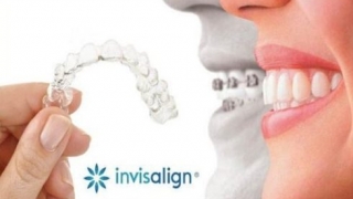 Niềng Invisalign có gì khác biệt so với khay thường?