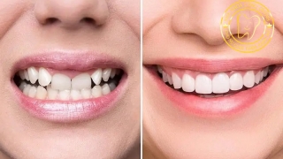 Niềng răng có bị hóp má không? Giải đáp chi tiết