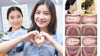Niềng răng có đau không?