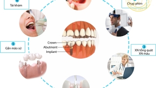 Quy trình cấy ghép Implant chuẩn Bộ Y Tế diễn ra như thế nào?