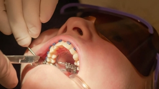 Tháo niềng: Quy trình – thời gian – cần lưu ý gì?