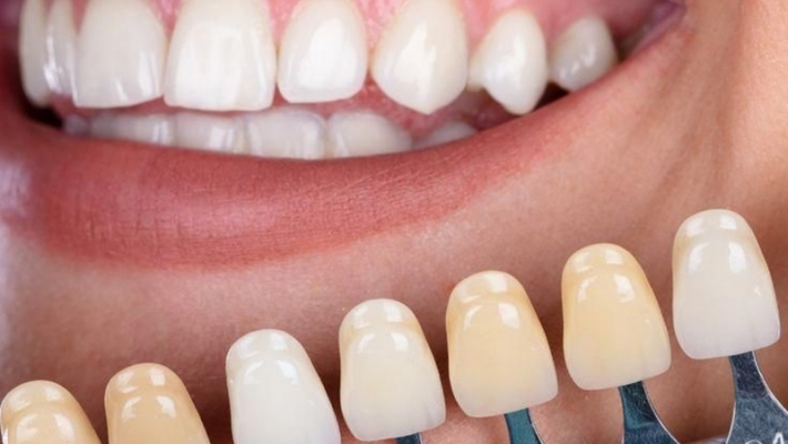 Veneer Composite tại Quận 1 – Giải pháp thẩm mỹ răng nhanh