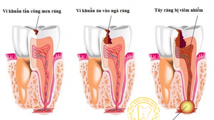 Chữa tủy răng trám MTA tại Quận 1 - Phương pháp điều trị tủy hiện đại