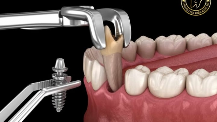 Mất một răng có nên trồng Implant ngay hay chờ thêm