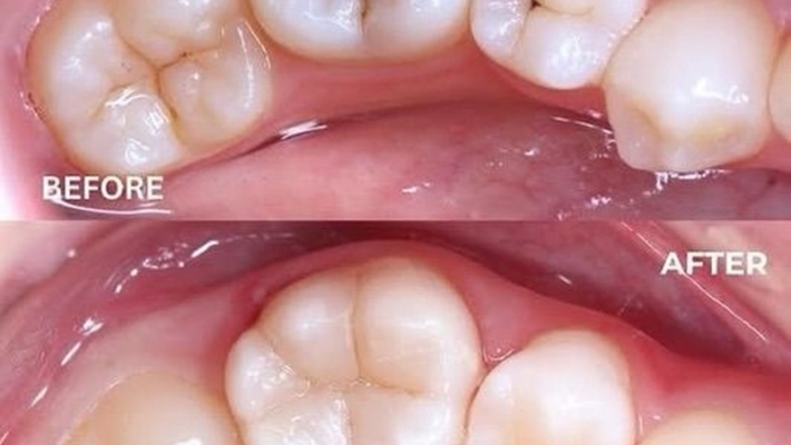 Trám răng thẩm mỹ Composite gần bạn ở TP.HCM