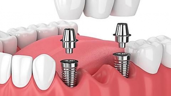 Cấy ghép implant 