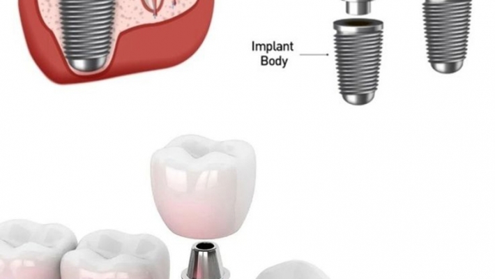 Implant ngắn cho xương hàm hạn chế – Giải pháp tối ưu