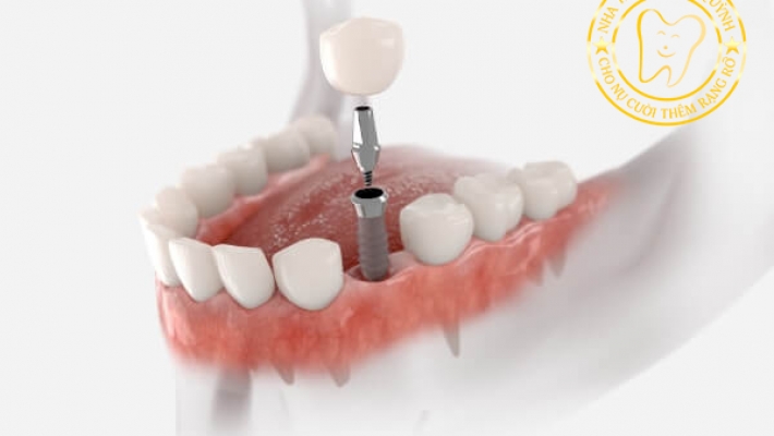 Phục hình răng sứ trên Implant tại TP.HCM – Nụ cười tự tin