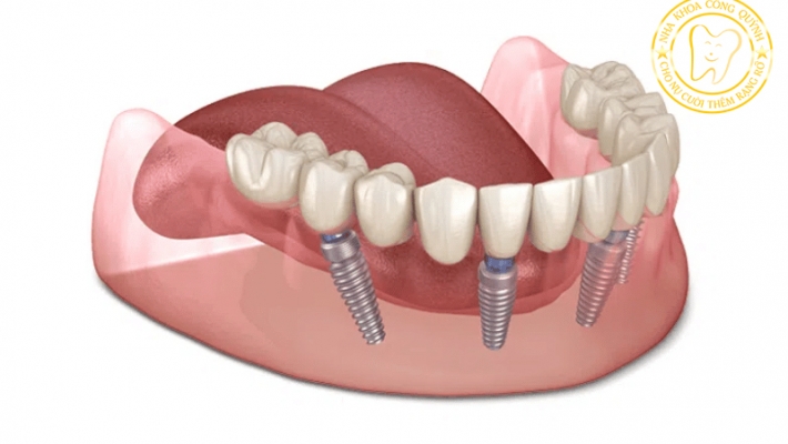 Trồng răng Implant All-on-4 Giải pháp phục hồi toàn hàm hiệu quả