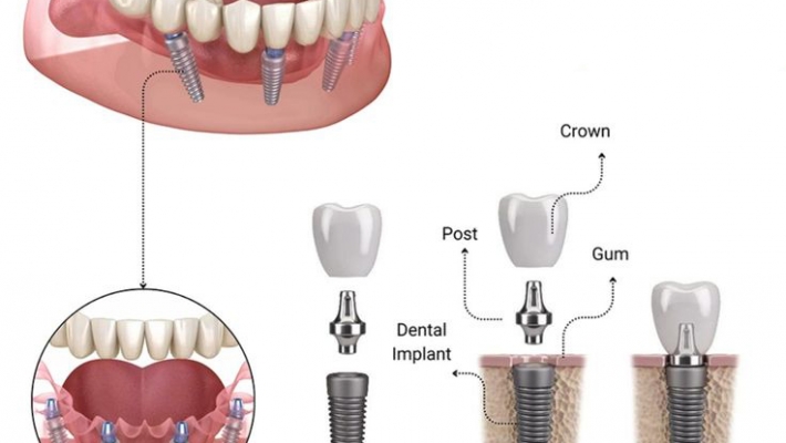 Quy trình cấy ghép Implant chuẩn y khoa tại Nha Khoa Cống Quỳnh
