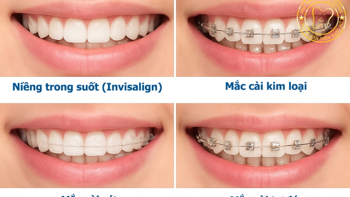 Niềng răng tại Quận 1 ở đâu uy tín ?