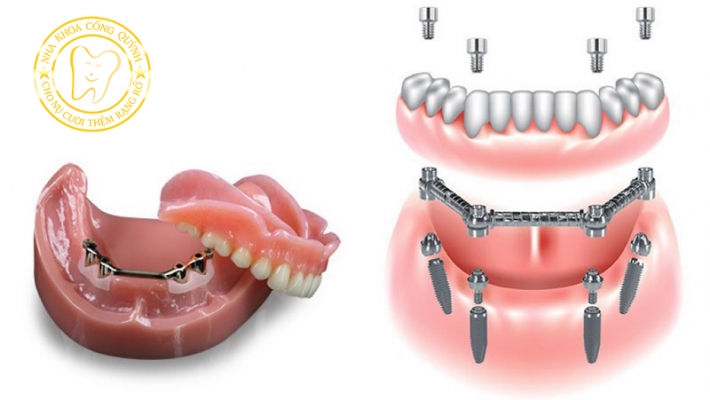 Implant cho người mất răng toàn hàm nên chọn All-on-4?