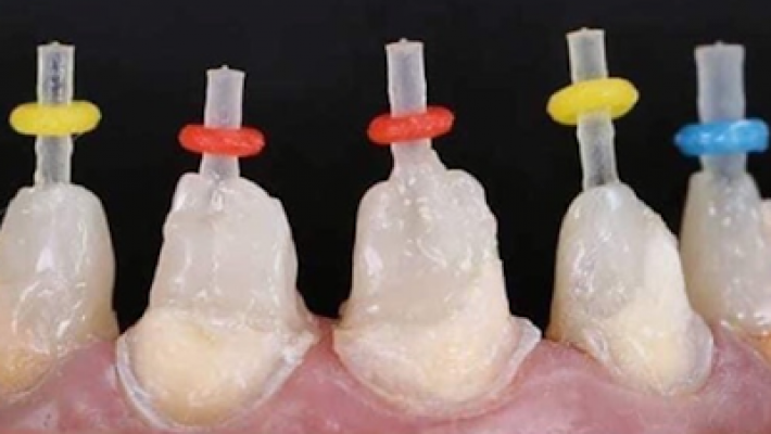 Trám Composite/GIC + Chốt