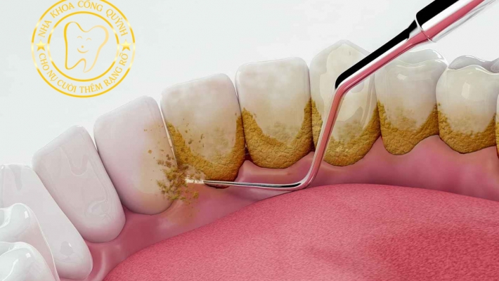 Cạo vôi răng