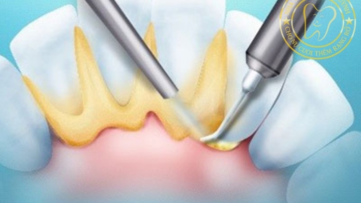 Tại sao cần lấy cao răng định kỳ 6 tháng/lần?
