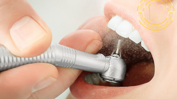 Ý nghĩa của cạo vôi và vệ sinh răng 