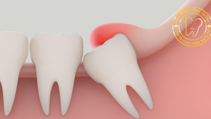 Tiểu phẫu cắt lợi trùm Quận 1 tại Nha Khoa Cống Quỳnh – Điều trị răng khôn mọc lệch