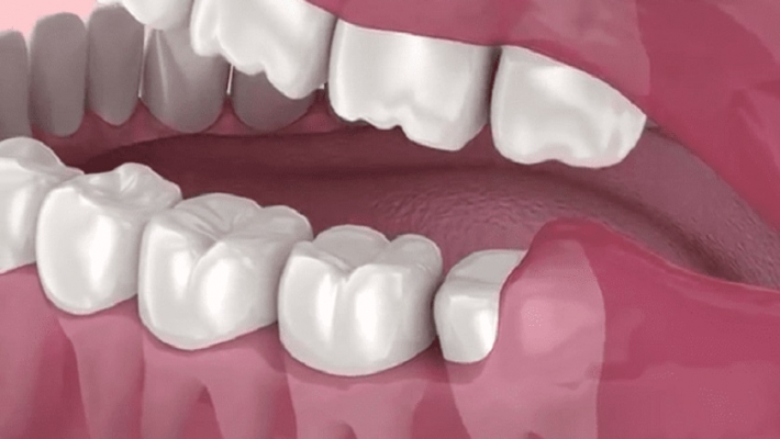 Tiểu phẩu cắt lợi trùm