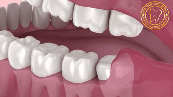 Tiểu phẩu cắt lợi trùm