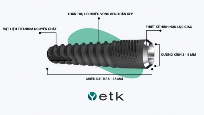 Mất răng lâu năm? Phục hồi bằng Implant ETK Pháp, an tâm trọn đời