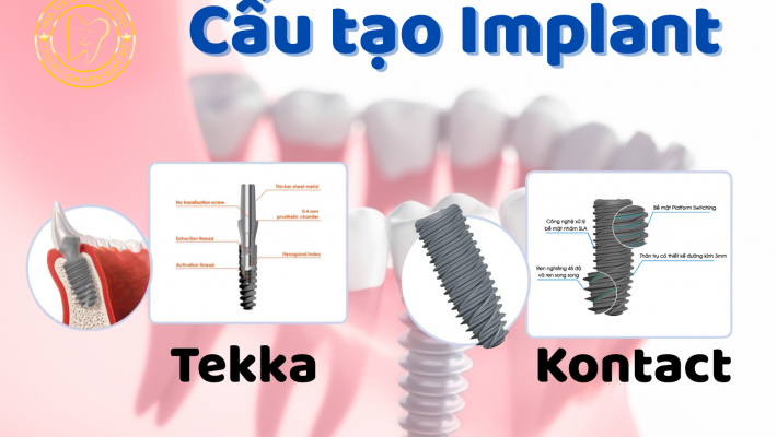 Implant Pháp – Giải pháp chất lượng cao, chi phí hợp lý cho phục hình răng mất