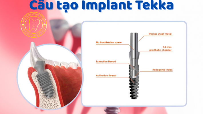 Ưu & Nhược điểm của Implant Pháp so với Implant Mỹ và Implant Thụy Sĩ
