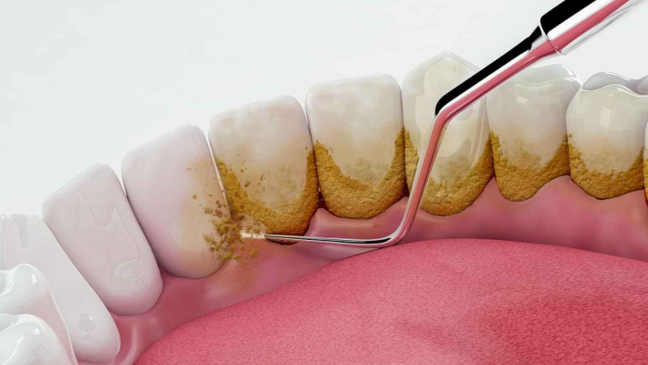 Cạo vôi răng