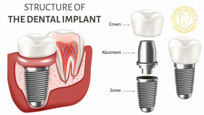 Răng sứ trên Implant là gì