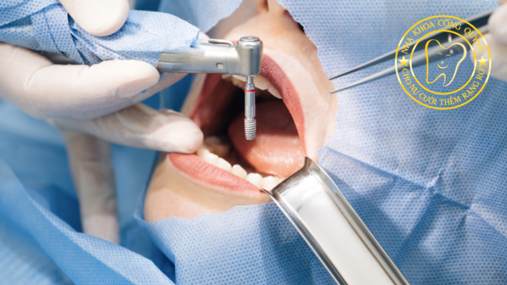 Những biến chứng nào có thể xảy ra khi trồng Implant và cách phòng tránh