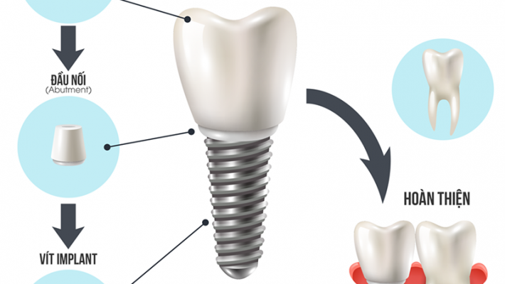 CẤY GHÉP IMPLANT TỨC THÌ – PHỤC HỒI RĂNG MẤT NGAY TRONG NGÀY
