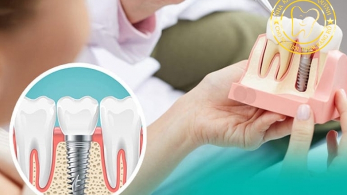 Làm răng Implant Q1 tại Nha Khoa Cống Quỳnh