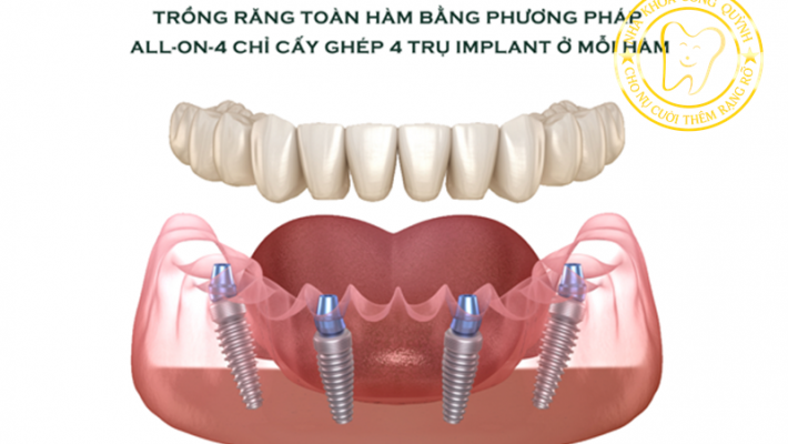 Giá trị thật của việc cắm Implant thay vì làm hàm giả