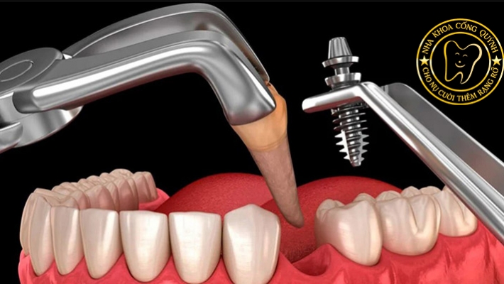 Cấy ghép Implant uy tín tại Quận 1 – Nha Khoa Cống Quỳnh