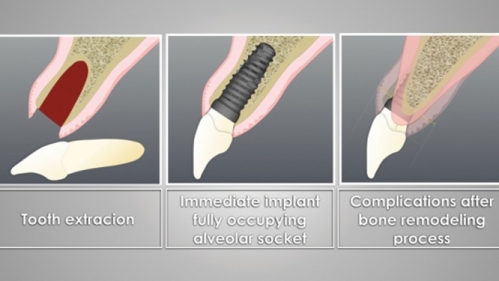 CẤY GHÉP IMPLANT TỨC THÌ SAU NHỔ RĂNG