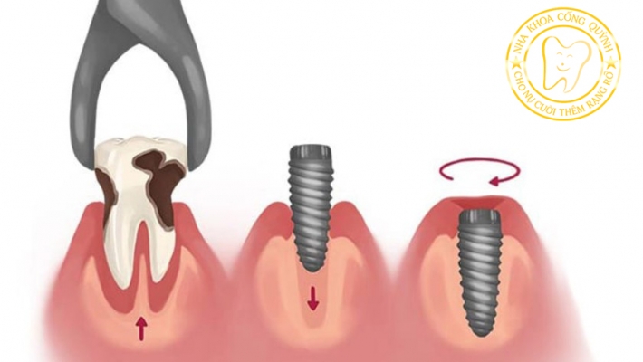 Vì sao trồng Implant sớm giúp bảo tồn xương hàm