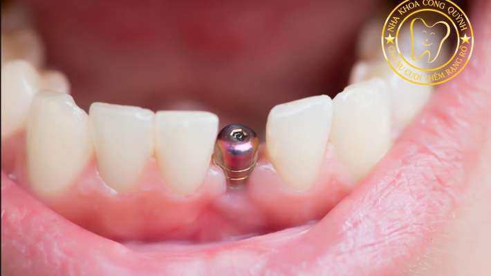 Vì sao mất răng lâu năm khiến việc trồng Implant phức tạp hơn
