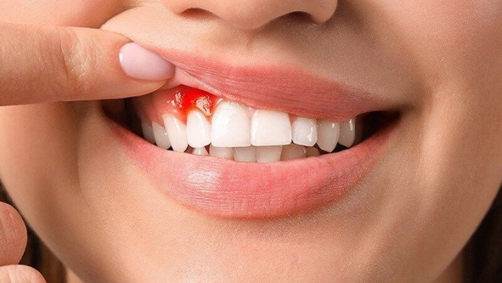 Tụt nướu và ảnh hưởng đến răng