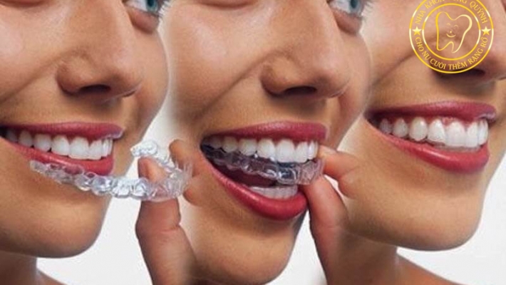 Niềng răng đầu năm – thay đổi nụ cười mà không ai nhận ra