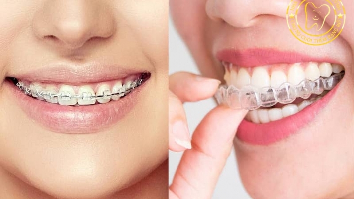 Niềng răng mắc cài và trong suốt – Lựa chọn chỉnh nha hiệu quả tại Quận 1