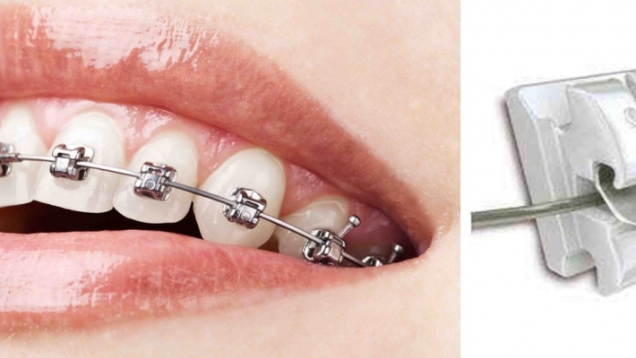 Niềng răng mắc cài kim loại: Ưu nhược điểm và chi phí thực tế