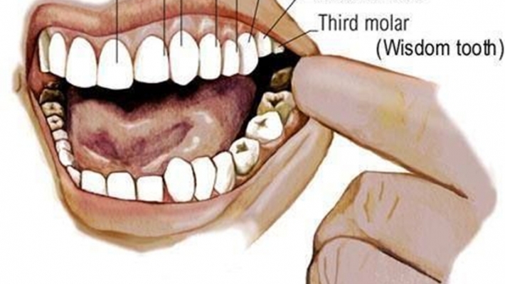 Các câu hỏi thường gặp về chữa răng?